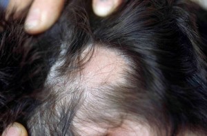 qc32e01-Alopecia1