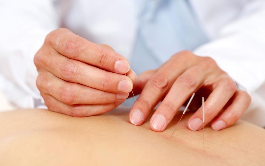 Wie wirkt Akupunktur?